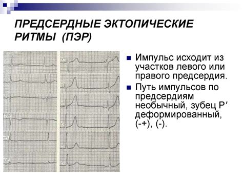 Осложнения предсердного ритма и последствия для сердца