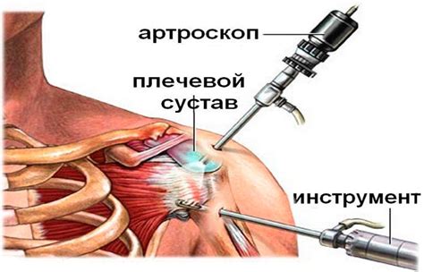 Осмотр плеча для выявления повреждений связок: процедуры и направления