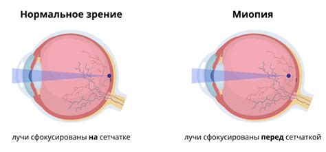Основные подходы и методы для диагностики и лечения высокой степени миопии у взрослых