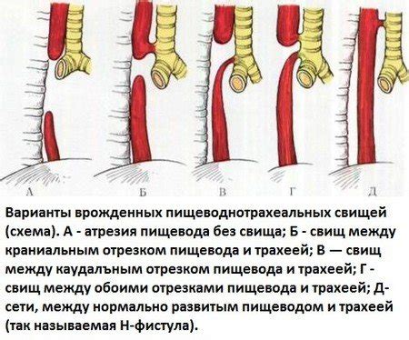 Основные признаки нарушения в верхней части пищевода