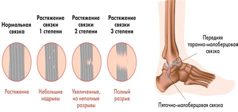Основные признаки растяжения связок на руке: как распознать повреждение
