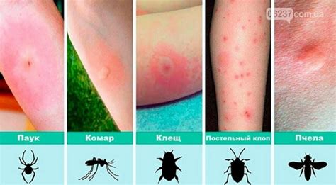 Основные причины отечности конечности в результате укуса насекомого