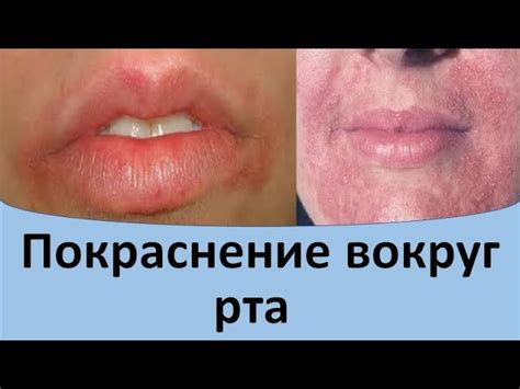 Основные способы избавления от красных пятен на щавеле