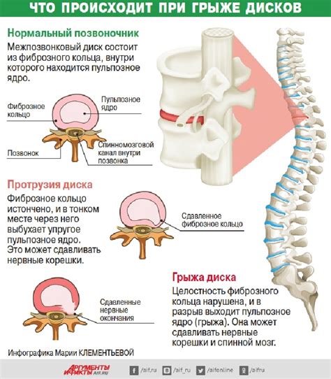 Основные характеристики и симптомы кисты позвоночника