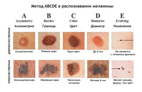 Особенности передачи меланомы у детей