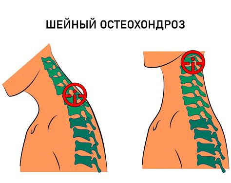 Остеохондроз