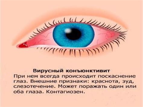 Очаги инфекций и конъюнктивиты