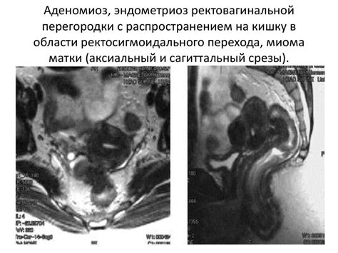 Патологии, связанные с распространением дискомфорта из почечной области в прямую кишку