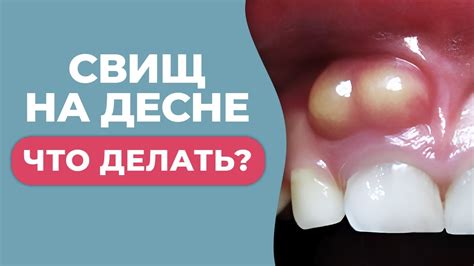 Первая помощь при нарыве на десне: что нужно сделать