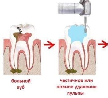 Питание при наличии свища на десне