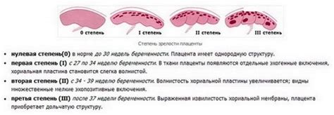 Плацента степени зрелости 2