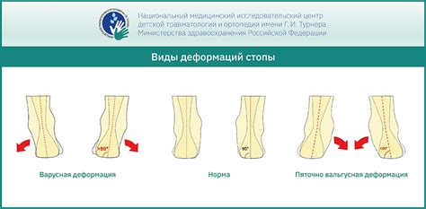 Плоскостопие и деформации стопы