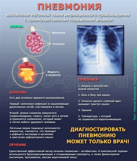 Пневмония: серьезное заболевание с многочисленными осложнениями