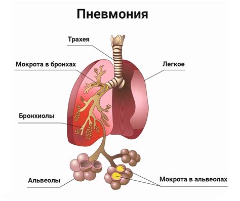 Пневмония и активность: как болезнь воздействует на двигательную функцию