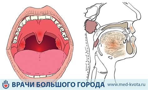 Повреждения голосовых связок