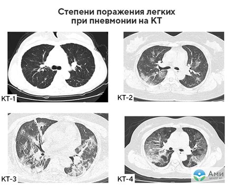 Повреждения легких от хлорида