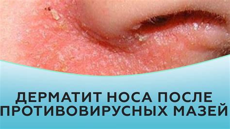 Покраснение и шелушение вокруг носа