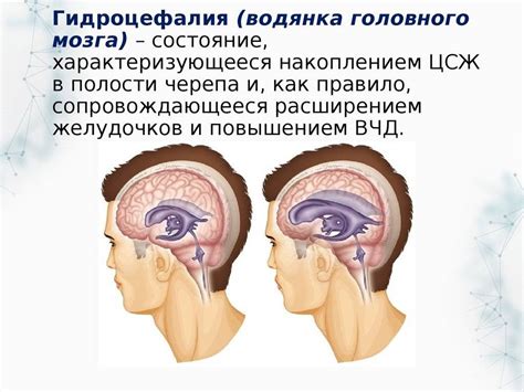 Понятие наружной заместительной гидроцефалии