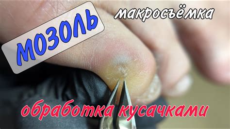 Популярные препараты для удаления гноя на пальце