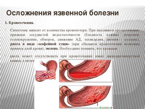 Последствия кровотечения у полипов