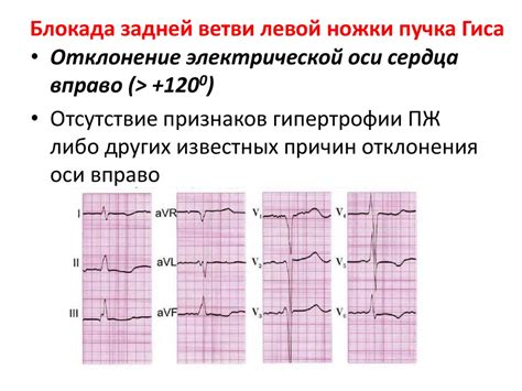 Последствия нарушения проводимости по правой ветви пучка Гиса для организма