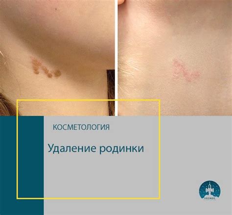 Последствия удаления висячих родинок: процесс регенерации и видимые следы