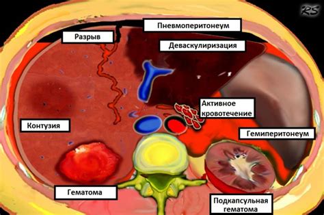 Потенциальные разрывы внутренних органов