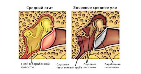 Почему не рекомендуется проводить прокачку воздуха в аудиторном проходе при воспалении среднего уха