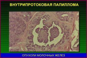 Появление внутрипротоковой папилломы