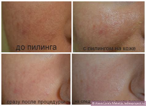 Правила применения энзимного пилинга