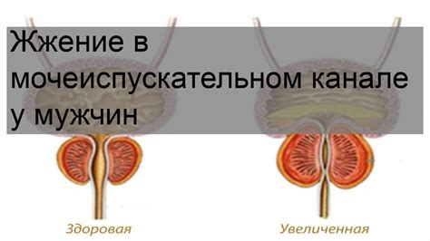 Предметы в мочеиспускательном канале: