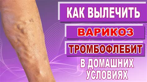 Предотвращение образования тромбов в нижних конечностях