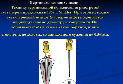 Преимущества горячей гуттаперчи