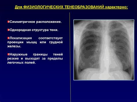 Преимущества и ограничения рентгеновской диагностики при обнаружении заболеваний органов дыхания