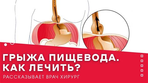 Преимущества употребления цикория при грыже пищевода: