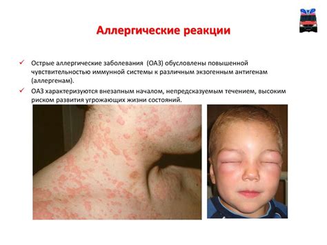 Признаки аллергических реакций на коже