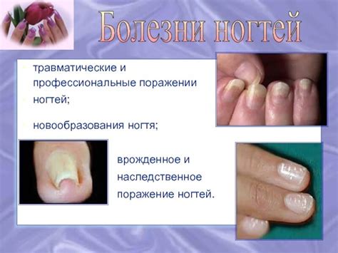 Применение эффективных методов при лечении проявлений заболевания ногтевого пласта