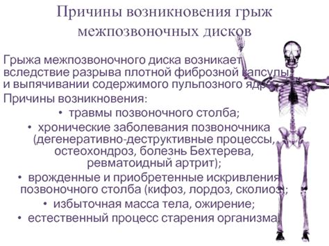 Причины возникновения грыж