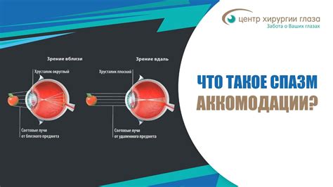 Причины возникновения напряжения аккомодации глаза