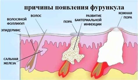 Причины возникновения нарывов под мышкой