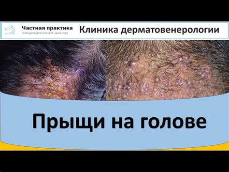 Причины возникновения подшерстка на голове у женщин