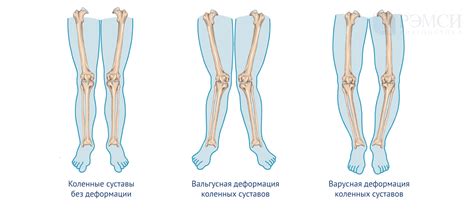 Причины выгибания ног в коленях в обратную сторону