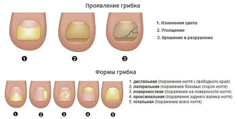 Причины и факторы, влияющие на утолщение ногтя