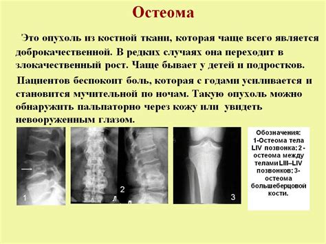 Причины нароста на ребре у взрослых