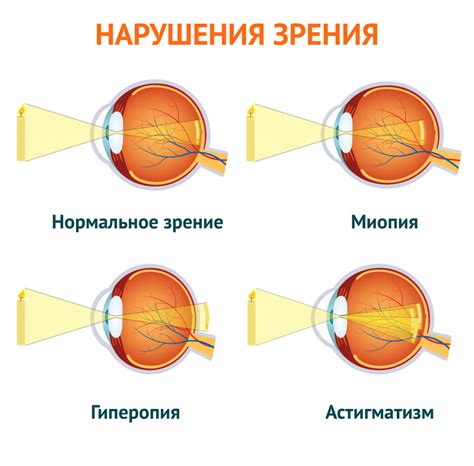 Причины нарушения аккомодации глаз у детей