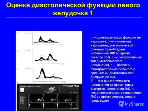 Причины нарушения диастолической функции