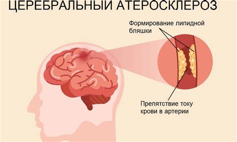 Причины образования ангиопатии головного мозга