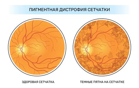 Причины образования пятен на сетчатке глаза