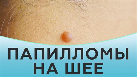 Причины появления папиллом на шее и подмышках