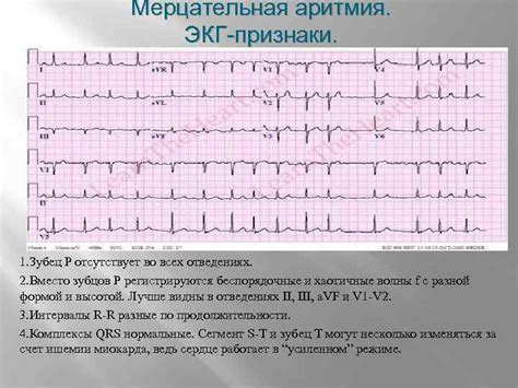 Причины предсердного ритма на ЭКГ